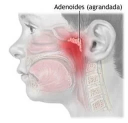 Adenoides ("Vegetaciones")