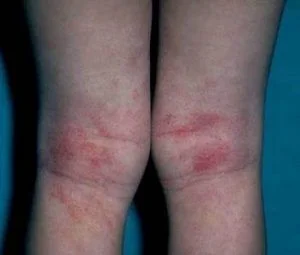dermatitis atópica piernas