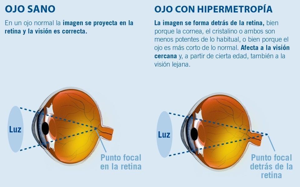 Miopia si hipermetropia-defecte de convergenta ale ochiului
